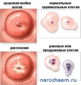 Норма и дисплазия