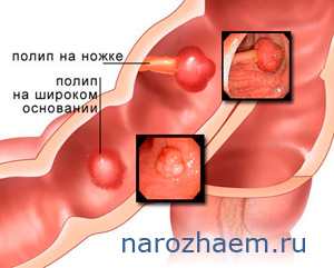 Полипы на тонкой ножке и широком основании