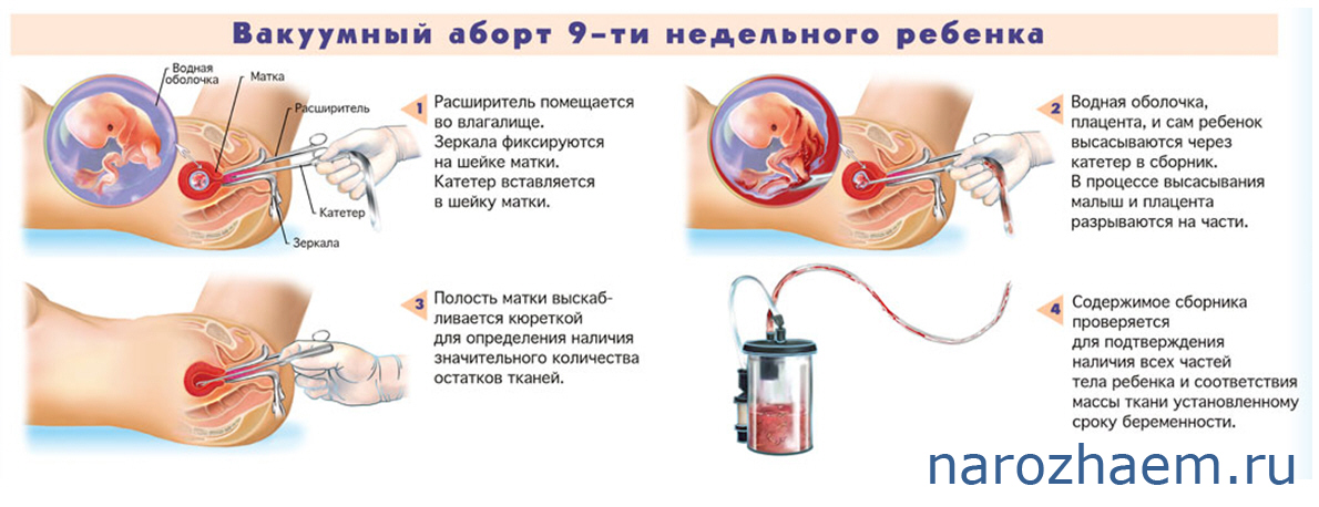 вакуумный аборт вакуумный аборт