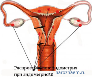 Причины причины эндометриоза