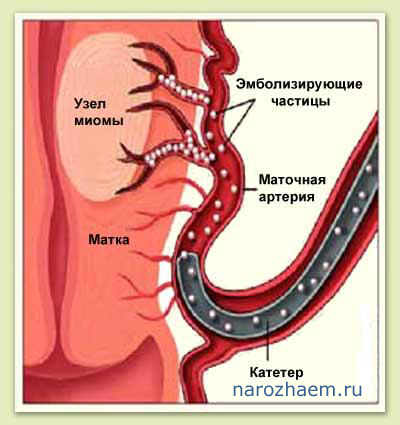 фибромиома лечение