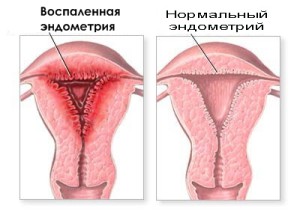 Эндометрит пусть даже если он хронический излечим.