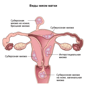 Миомы матки бывают различными