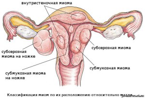Субсерозная миома матки