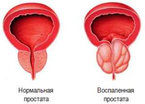 Почему происходит воспаление простаты