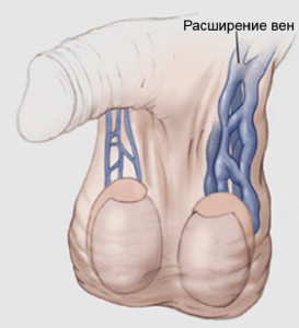 расширение вен