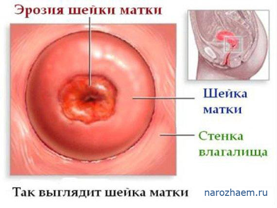 Картинка с изображением эрозии