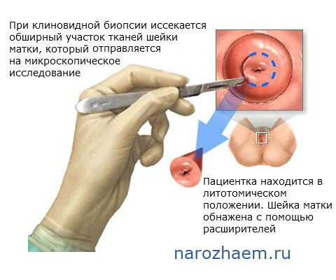 Конизация шейки матки