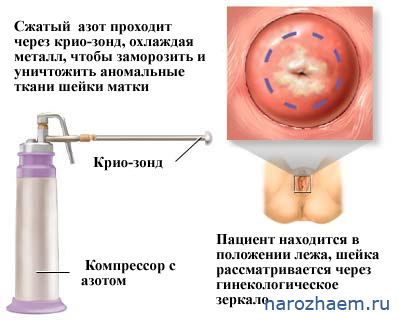 Суть процедуры