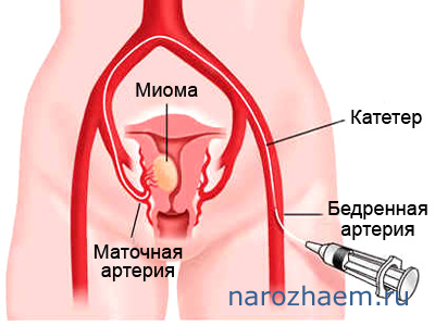 Эмболизация маточных артерий