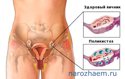Показаны больной и здоровый яичники