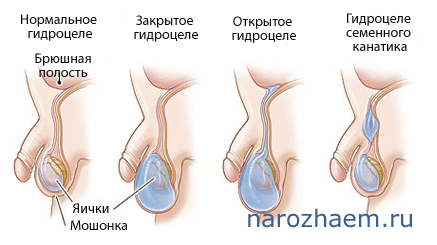 Водянка яичка бывает различных видов