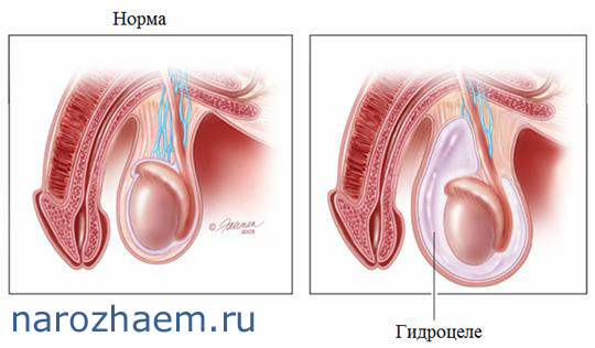 строение мужской половой системы - норма и водянка яичка