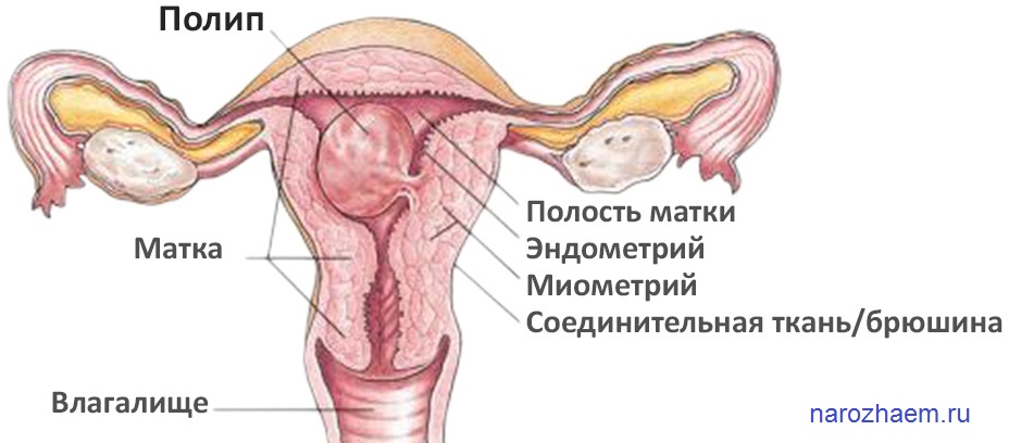Полип цервикального канала
